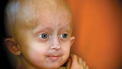 Erken Yaşlanma Hastalığı (Progeria)