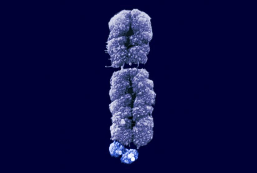 Kırılgan X Kromozomunun mikroskop altında görüntüsü. Sendrom adını, kopmak üzere gibi görünen kısımdan almıştır.