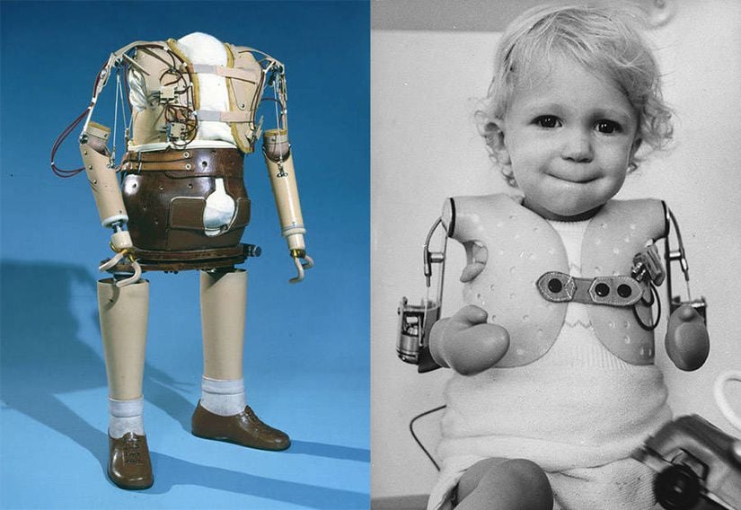 Uzuvları gelişmeden doğan bir Alman bebek için geliştirilen protez uzuvlar (1960).