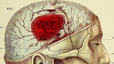Beyin Kanaması Nedir? Beyin Kanaması Geçirdiğinizi Nasıl Anlarsınız?