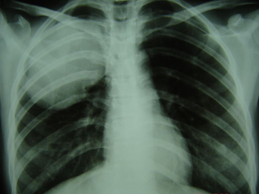 Akciğer yerleşimli hidatik kistin röntgen görüntüsü.
