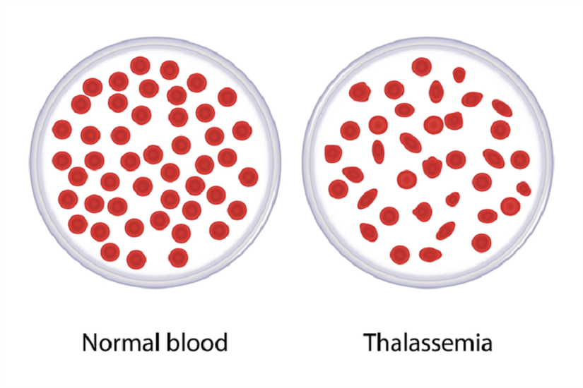 Normal eritrositler( kırmızı kan hücreleri) ve Talesemi hastalığında eritrositler