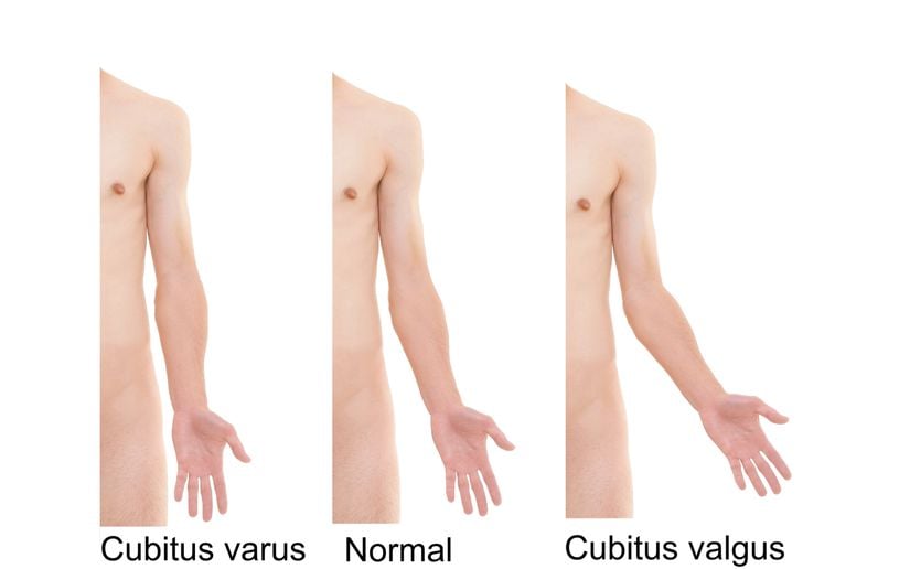 Cubitus valgus, ön kolun tamamen uzatıldığında vücuttan normalden daha fazla açılı olduğu tıbbi bir deformitedir.
