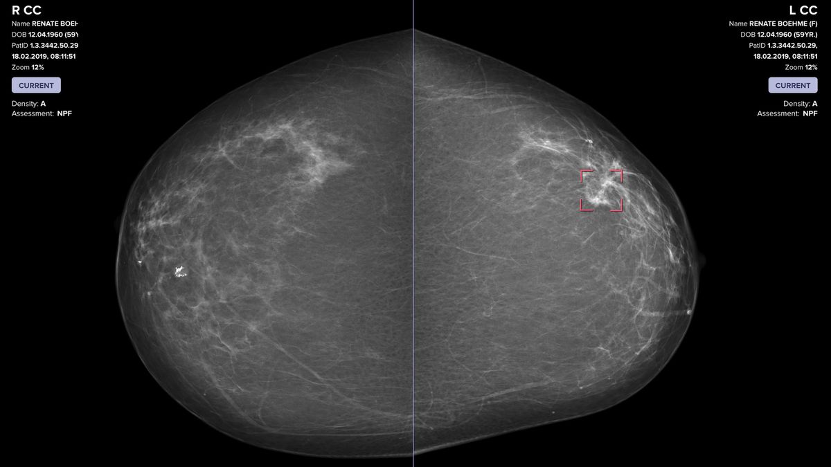 AI Innovations Enhance Breast Cancer Diagnostics