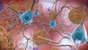 Breakthrough Drug Offers Hope In Alzheimer's Treatment