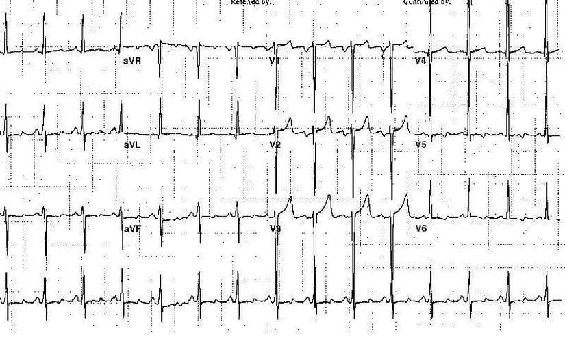 Uzun süredir kontrolsüz hipertansiyon öyküsü olan 47 yaşındaki bir erkeğe ait elektrokardiyogram (EKG). Bu görüntü sol atriyal genişlemeyi ve sol ventrikül hipertrofisini göstermektedir.