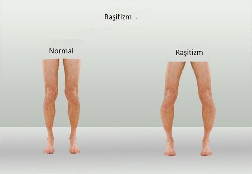 D vitamini eksikliğinden kaynaklanan raşitizm hastalığında bacak normal halinden daha çarpık bir hal alır.