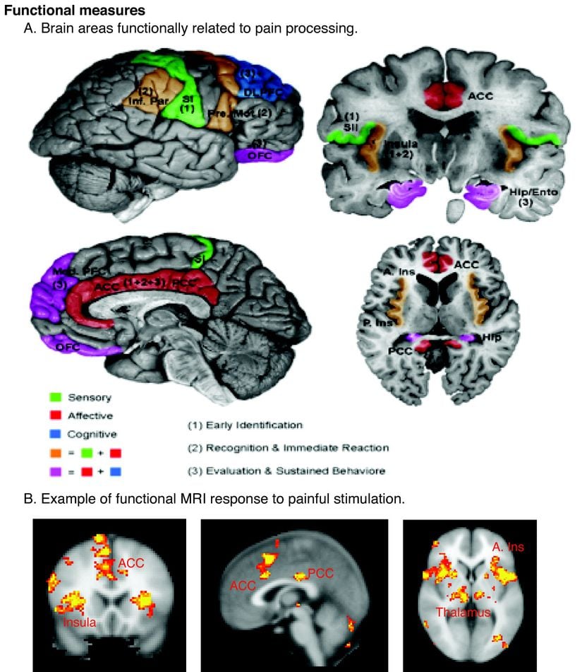 Acı Çeken Beynin fMRI Görüntüsü