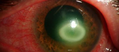 Uzun Süreli Lens Kullanımı ve Amip Temelli Hastalıklar