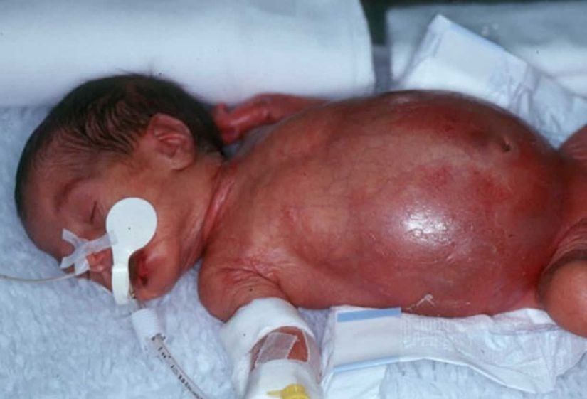 Nekrotizan enterokolit hastası bir bebek