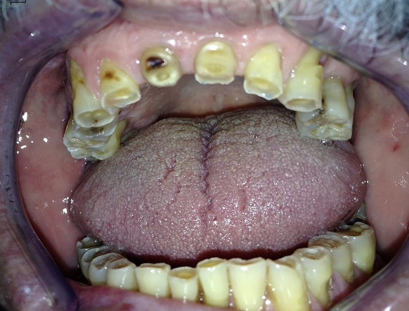 Bruksizm sonucu aşınmış dişlerin klinik görünümü