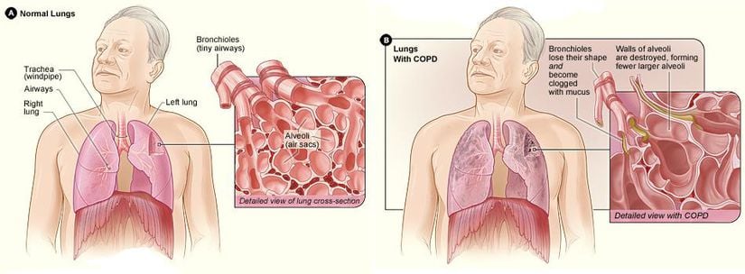 Normal akciğerler sol diyagramda gösterilmiştir. Akciğerler KOAH tarafından hasar görmüş, sağ diyagramda mukus tarafından bloke edilen bronşiyollerin bir kesitini gösteren bir ek ve hasarlı alveoller.