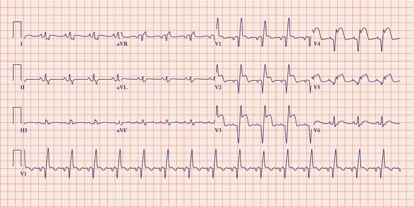 ST-segment yükselmeli miyokard enfarktüsünün bir EKG örneği