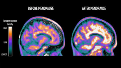 Beyin Görüntüleme Çalışması, Menopoz Sırasında Östrojen Seviyesinin Değiştiğini Ortaya Koyuyor!