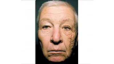 Tek Yönlü Dermatoheliyoz: Yüzünün Tek Tarafı, Güneş Nedeniyle Daha Fazla 