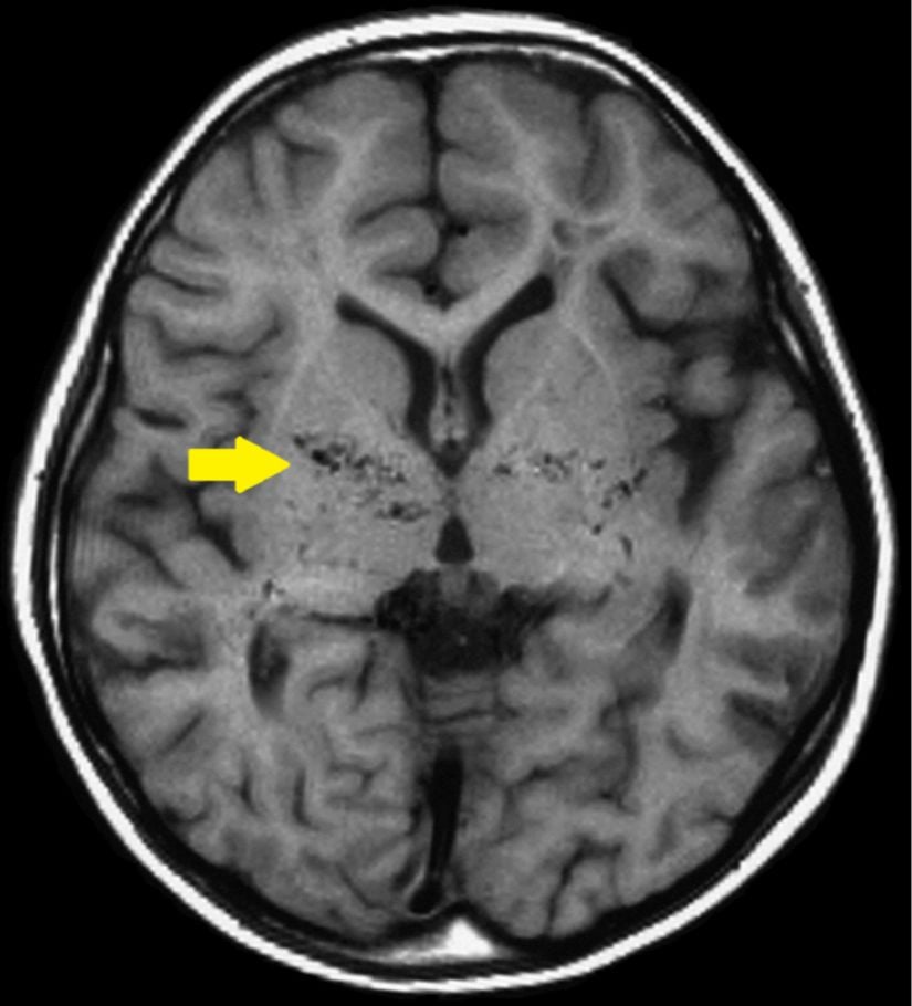 Moyamoya hastalığının T1 ağırlıklı MR görüntüsü. Bazal ganglionda görülen akım boşluğu ok ile işaretlenmiştir.