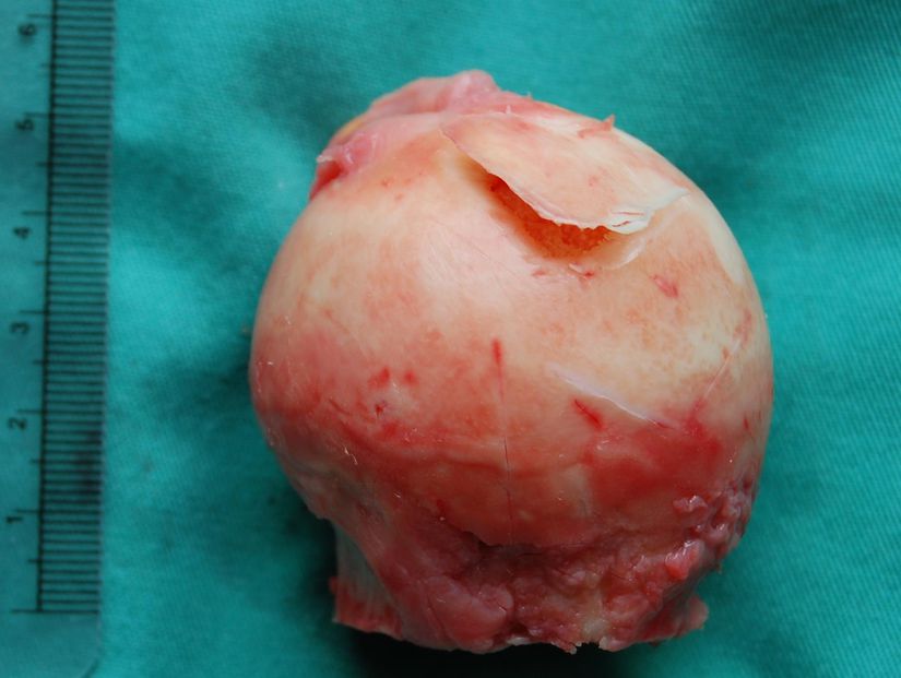 Avasküler nekroz nedeniyle kıkırdak flebi gösteren femur başı. Total kalça protezi ameliyatı sonrası alınan örnek (sol kalça).
