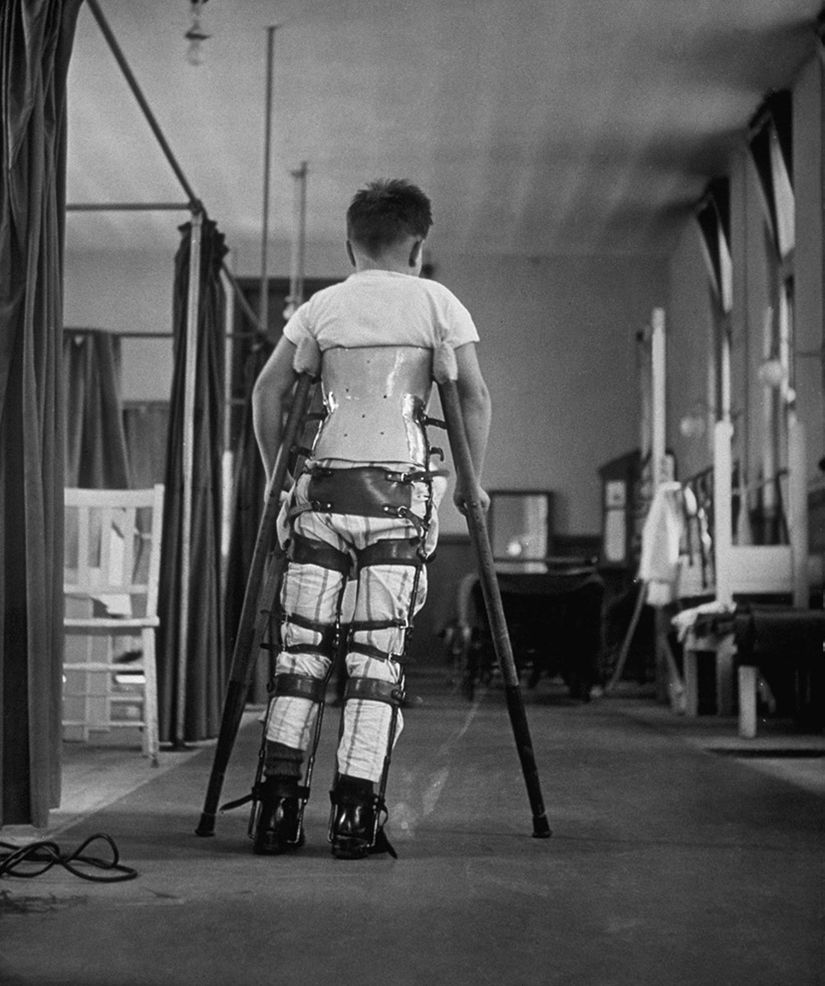 Çocuk felci (poliyomiyelit) hastası bir çocuk, desteklerle yürümeye çalışırken.