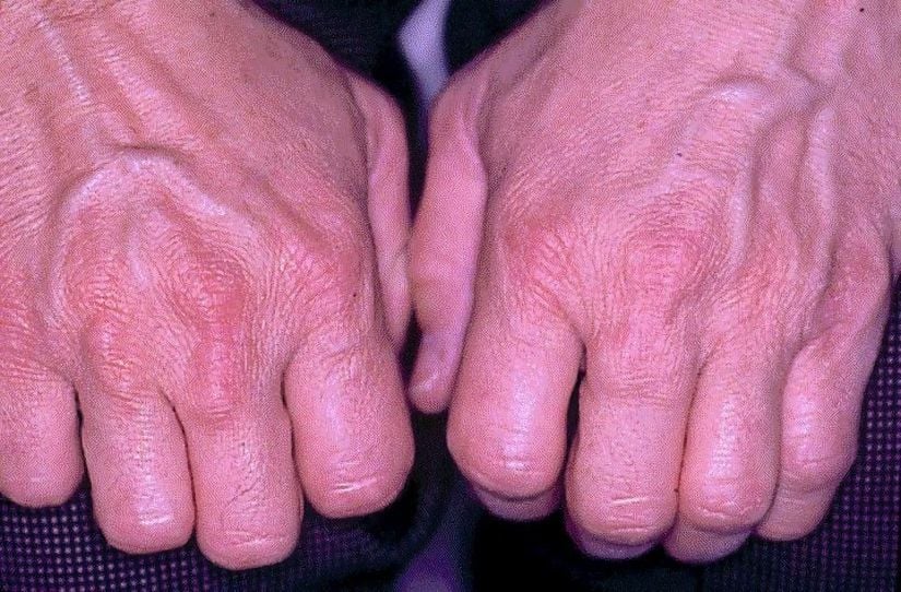 Heterozigot Ailesel Hiperkolesterolemili 45 yaşındaki bir erkekte metakarpofalangeal eklem tendon ksantomları