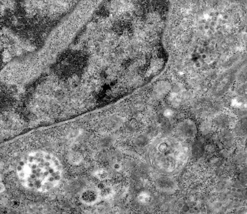 Hücrenin içine giren ve kendini kopyalayan virüs partikülleri (büyük beyaz içinde koyu lekeler)