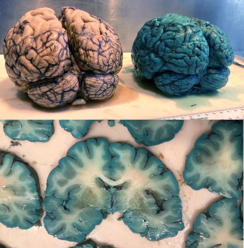 Metilen mavisiyle boyanmış insan beyni.