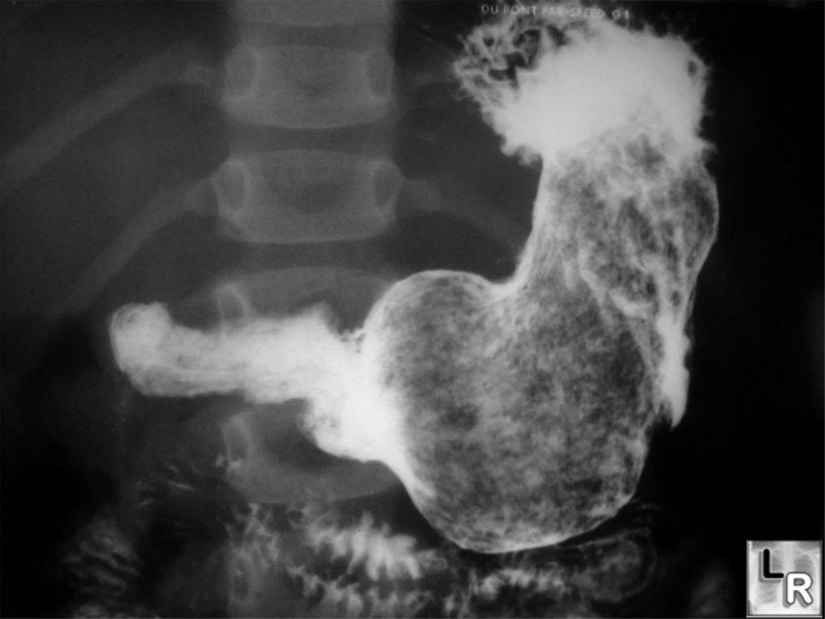 14 yaşındaki bir zihinsel hastanın midesinin X-ışını taramasıyla elde edilen görüntüsü... Devasa bir trakobezoar (kıl yumağı) açıkça görülüyor.
