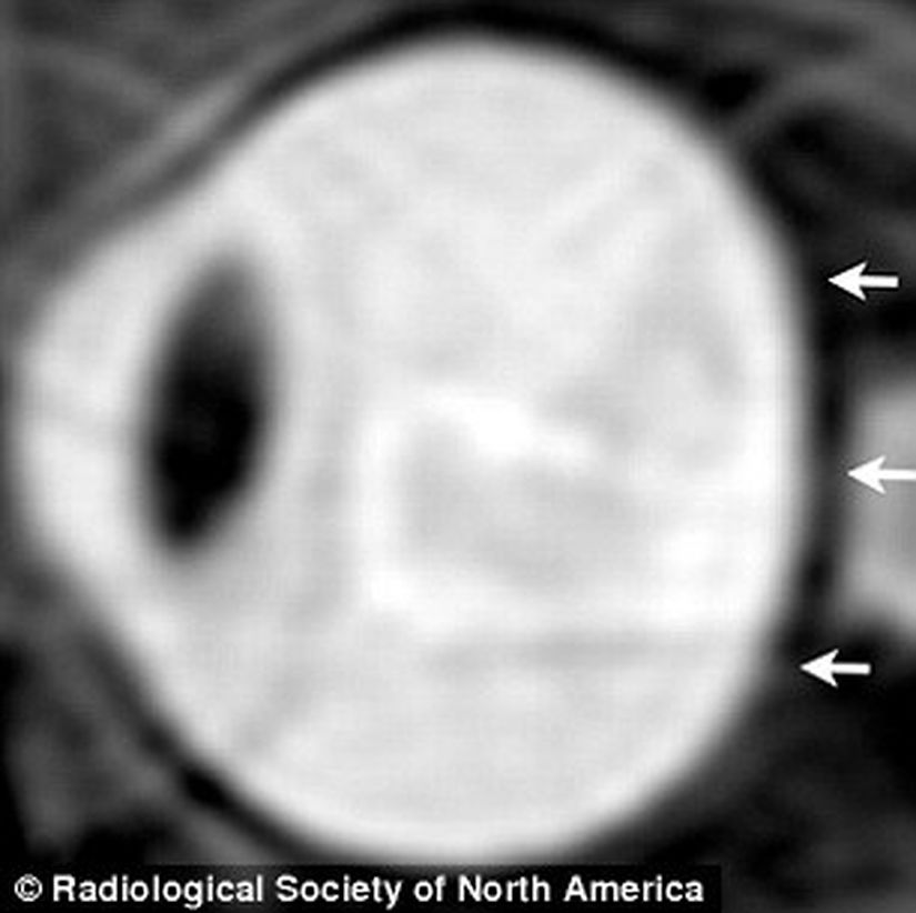 2012'de gerçekleşen uzun uzay uçuşu öncesi bir astronotun göz yuvarının arka tarafı 'normal' halde görülüyor.