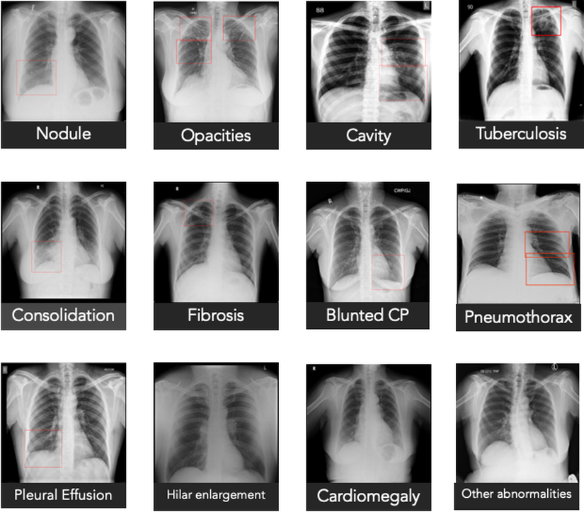 Qure.ai qXR sisteminin tespit edebileceği akciğer anomalileri