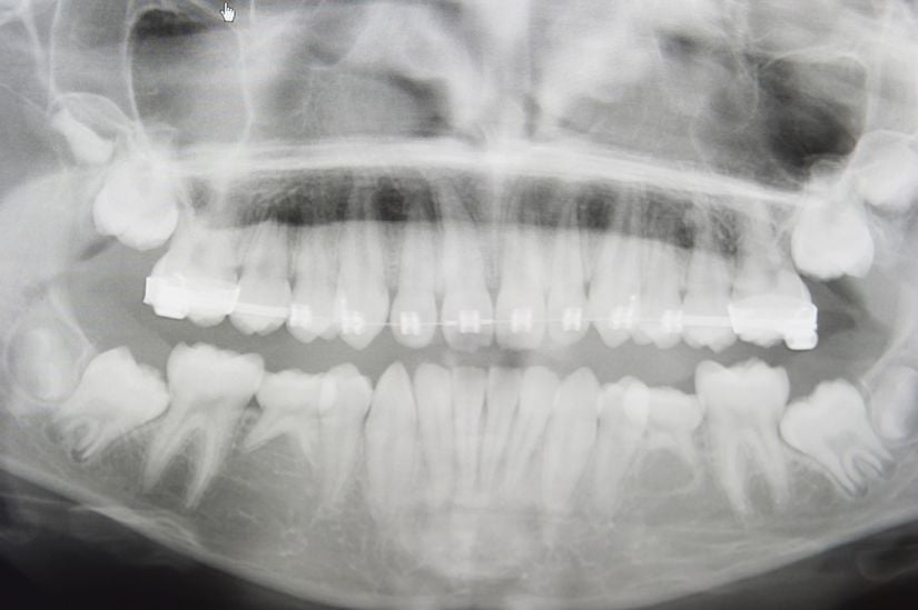 En dış taraftaki dişler 20 yaş dişleridir.
