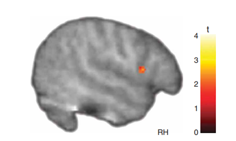 Şekil 4: Duygusal ifadelerin gözlemlenmesi sırasında ayna nöron sistemi aktivitesi. Sağ pars opercularis, tipik olarak gelişmekte olan çocuklarda OSB'li çocuklara kıyasla önemli ölçüde daha fazla aktivite göstermiştir.