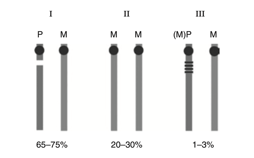 Prader-Willi Sendromu'nun genetik sınıfları ve ortalama frekansları (I: Delesyon, II: Uniparental Disomi, III: Imprinting Defekti).