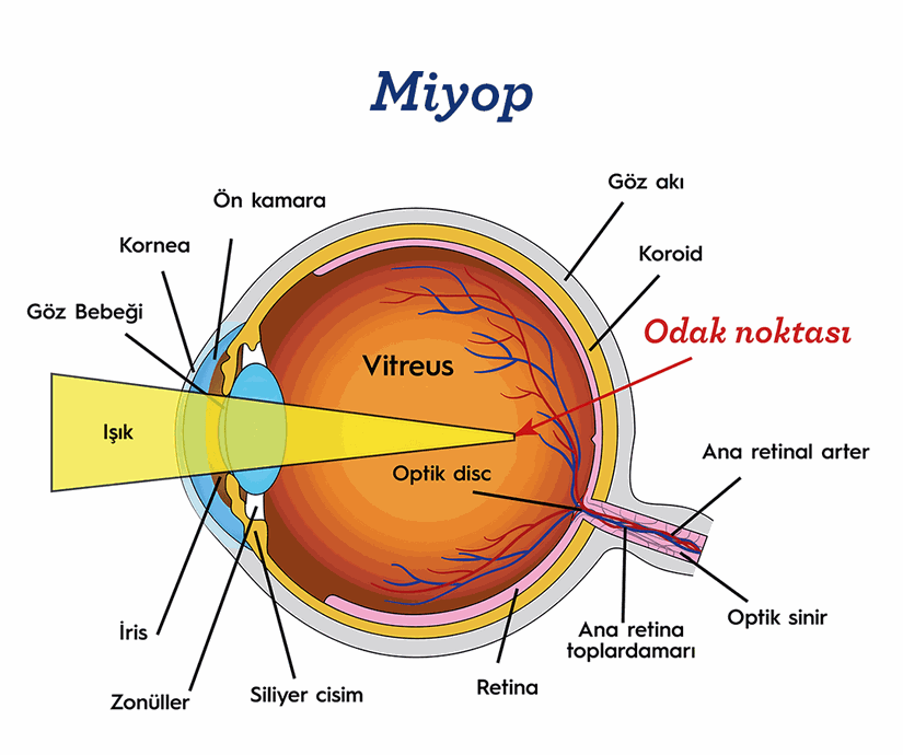 Miyop rahatsızlığının tipik şeması. Işık, normal işlev gören gözde retina tabakasına düşer. Ancak miyopi olan gözde ışık, sarı cismin önüne düşer (kırmızı ok)