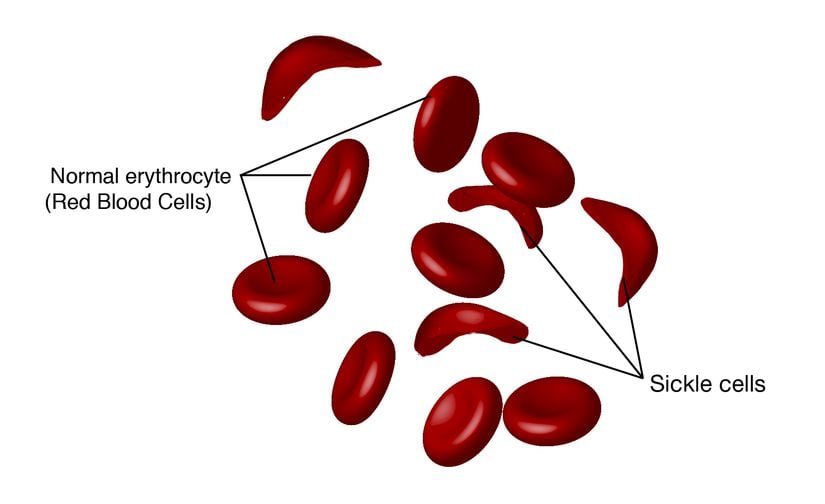 Normal Eritrositler (Normal erythrocyte) ve Orak hücreler (sickle cell)