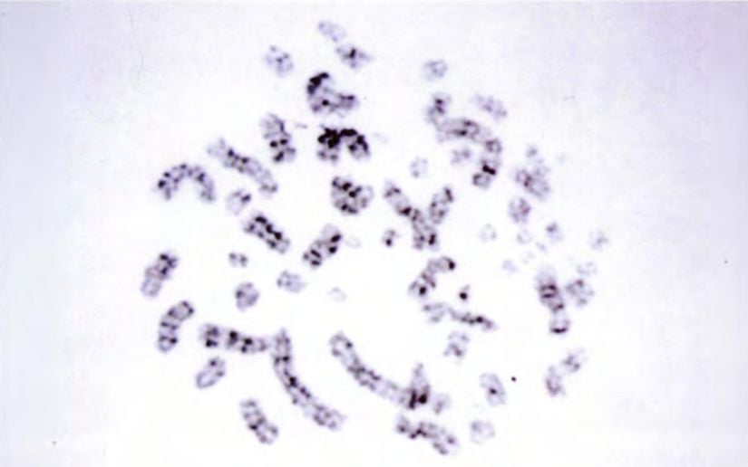 3 Ekim 1999 günü, radyasyondan 4 gün sonra dizilenen kromozomların mikrografı. İlyak kemiği iliğinden alınan örneklerde kromozomların tanımlanamayacak kadar parçalandığı görülüyor.
