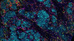 Kanser Mikroçevresi: Bir Kanser Hücresi Nasıl Bir Ortamda Yaşar? O Ortamı Nasıl Dönüştürür?