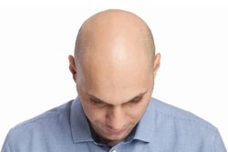 Kellik için Potansiyel Tedavi: Saç Köklerinde Yaşamı ve Ölümü Kontrol Eden Kimyasalın Keşfi