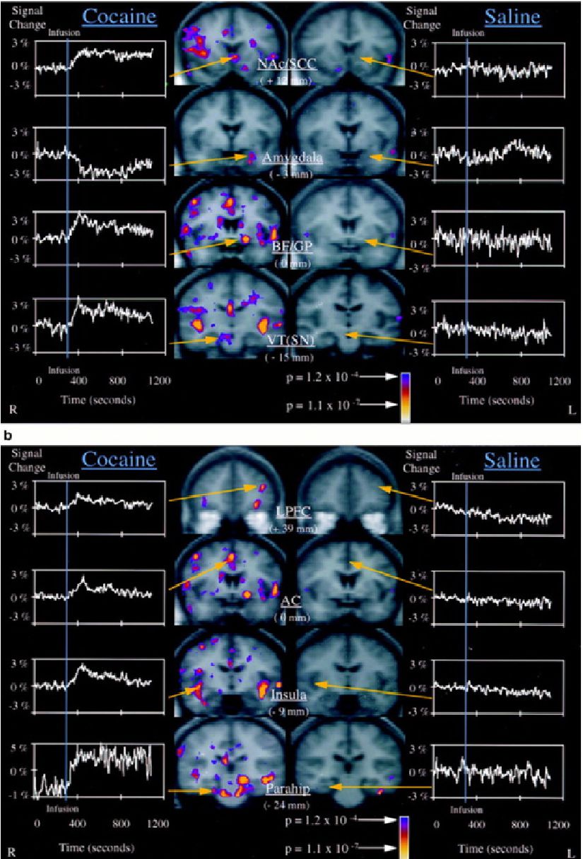 Şekil 1. Kokain ve Salin ile Bölgesel Beyin Aktivasyonu   (a) Kokainden sonra önemli fMRI sinyal değişiklikleri gösteren, ancak salininfüzyonlarından sonra olmayan subkortikal beyin bölgelerinin görüntüleri. Solda, kokain alan on denekten ortalama fMRI verileri için infüzyon öncesi ve sonrası zaman noktalarının dört koronal seviyesindeki Kolmogorov-Smirnov (KS) istatistiksel haritaları bulunmaktadır. Bu KS istatistiksel haritaları, karşılık gelen gri tonlamalı ortalama yapısal haritalar üzerinde sözde renkte kaplanmıştır. Pozitif sinyal değişikliği olan aktivasyonlar NAc/SCC, BF/GP ve VT'yi içerirken, negatif sinyal değişikliği olan aktivasyonlar amigdalayı içerir.   (b) Kokain ve salininfüzyonlarından sonra diğer paralimbik ve heteromodal korteks aktivasyonlarının görüntüleri. Gösterilen bölgeler arasında lateralprefrontal korteks (LPFC), anteriorsingulat, insula ve parahipokampalgirus bulunur. Görüntü ve grafik düzeni (a)'da açıklanan kuralları takip eder.