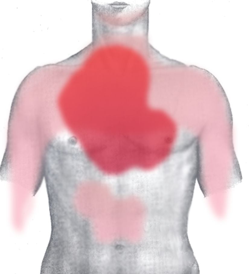 Kalp krizi geçiren hastaların hissettiği ağrı yoğunluğunun vücuttaki dağılımının temsili. Ağrı, genellikle göğüste ve sırtta (koyu kırmızı alan) daha yoğunken, diğer bölgelerde (açık kırmızı alanlar) daha az yoğunlukta hissedilebilir.