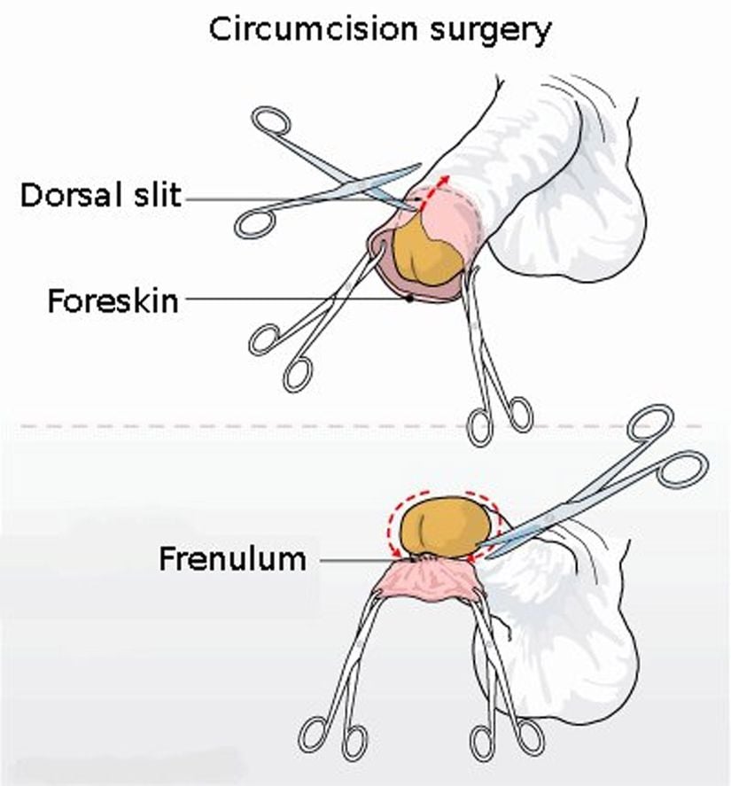 Klasik bir sünnet ameliyatı