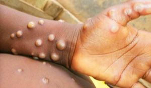 Thailand Detects Suspected Case Of New Mpox Variant