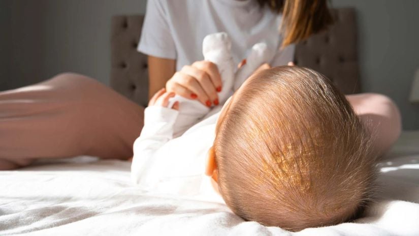 Bebeklerde sıkça görülen seboreik dermatit örneği.