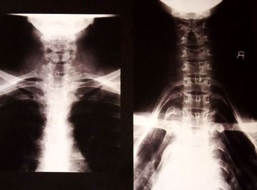 X-ray Görüntüleri: 1.Normal bir boyun 2. Boyun uzatma amaçlı halkaların takılıp çıkarılmış olduğu bir boyun