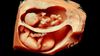 Bir Bebeğin 3 Boyutlu ve 4 Boyutlu Ultrason Görüntülerini Almak Mümkün ve Bu, Sigaranın Bebekler Üzerindeki Zararlarını Gösteriyor!