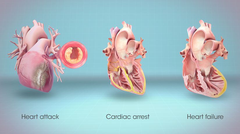 Kalp krizi, ani kalp durması ve kalp yetmezliği arasındaki farkları gösteren illüstrasyon.
