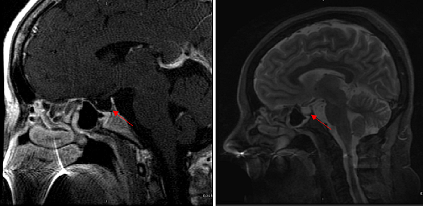 Beynin boş bir sellayı gösteren MR görüntüsü