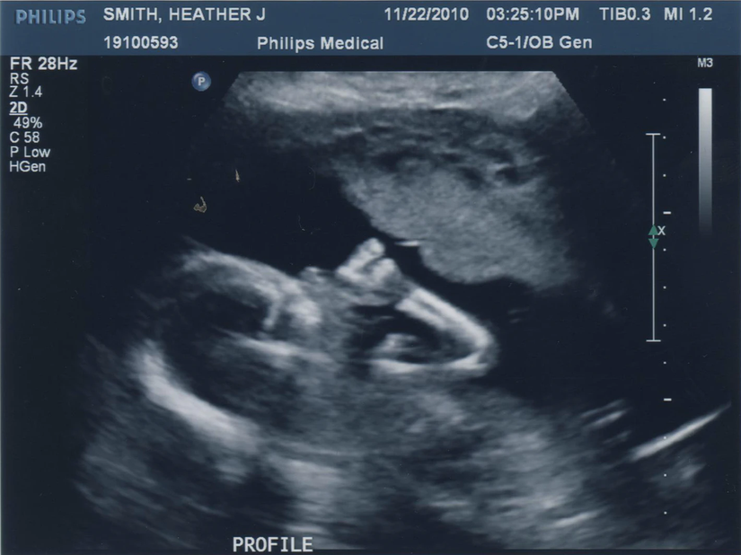19 haftalık bir fetüste parmak emme davranışını gösteren bir ultrason fotoğrafı. Bu bebekte el tercihi 13. haftada belirlenmiştir.