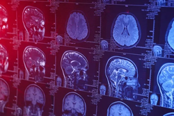 Yeni Yapay Zeka Aracı Beyin Tümörü Sınıflandırmasını Hızlandırıyor!
