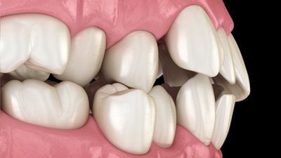 Dişler Aslında Kemik mi? Dişler Nasıl Gelişir?