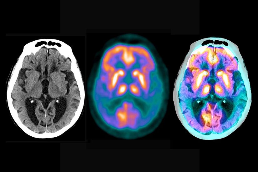 Alzheimer'ın beynin bazı bölgelerine verdiği zarar