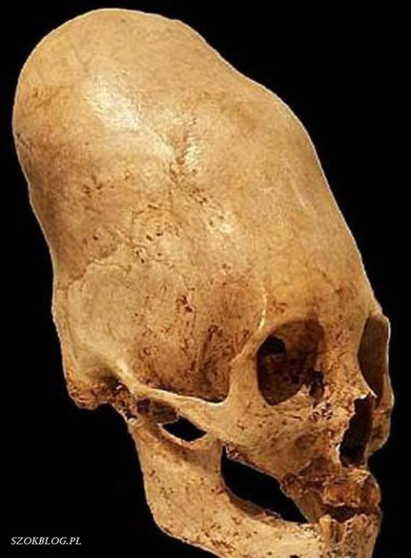 Homo capensis. Гунны удлиненные черепа. Деформация черепов Паракас. Трепанация черепа Паракас.